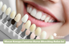 ALASAN KENAPA KAMU HARUS PILIH BLEACHING GIGI BULAN INI
