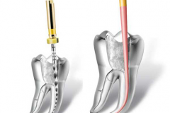 ENDODONTIC TREATMENT