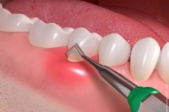 PERIODONTAL TREATMENT