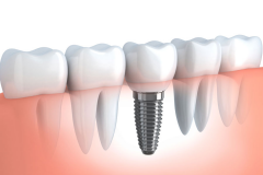 DENTAL IMPLANT