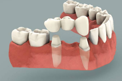 DENTAL CROWN AND BRIDGES