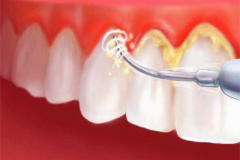 SCALING AND POLISHING