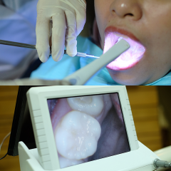 INTRA ORAL CAMERA